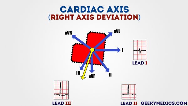 Right-axis-deviationwatermarked-600x338.jpg