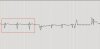 ekg_chest_1_highlited.JPG